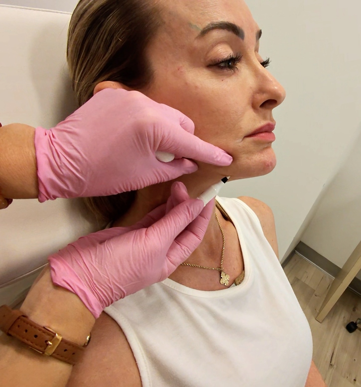 Injector training — jawline filler technique on live model