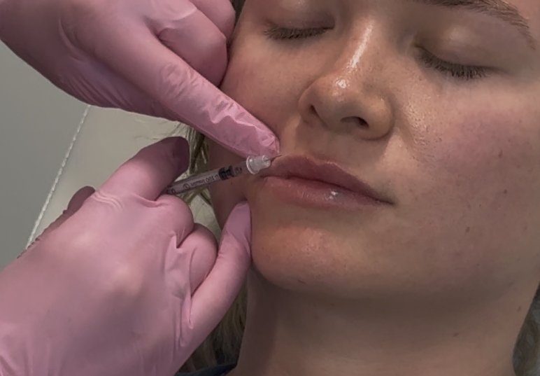 Close-up lip filler injection during hands-on training